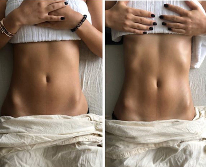 Before-and-after photo of a woman's abdomen: left shows a fuller waist, right shows a slimmer, more defined midsection.